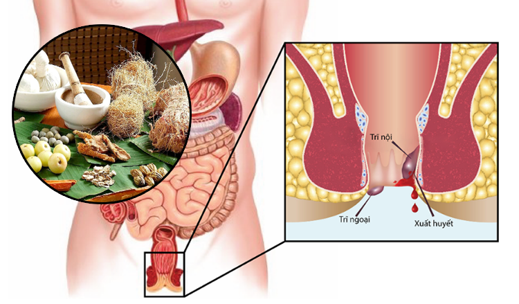 Bài thuốc Đông y điều trị bệnh trĩ